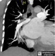 Pulmonary Artery